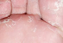 what causes white dry skin on feet