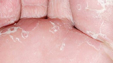 what causes white dry skin on feet