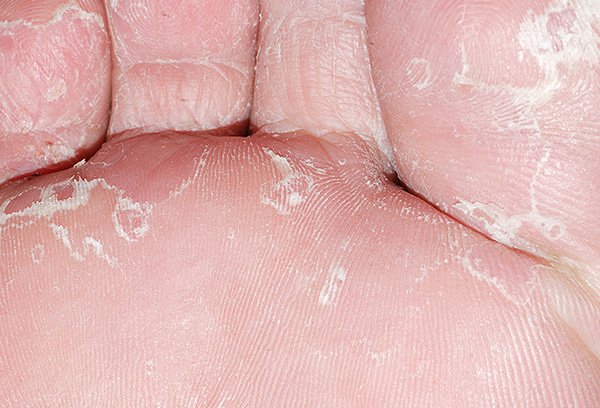 what causes white dry skin on feet
